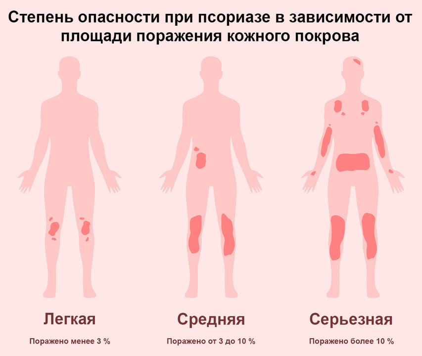 Псориаз у ребенка 2 года фото