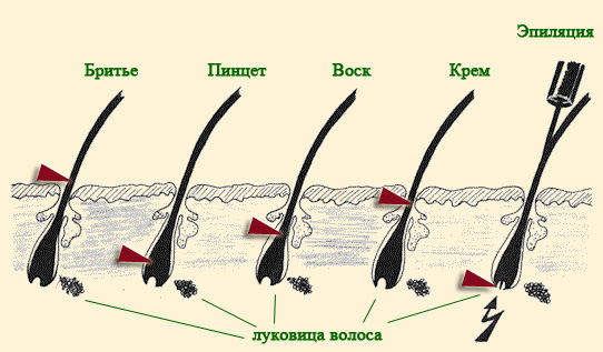 Классическое бикини лазерная эпиляция что входит фото