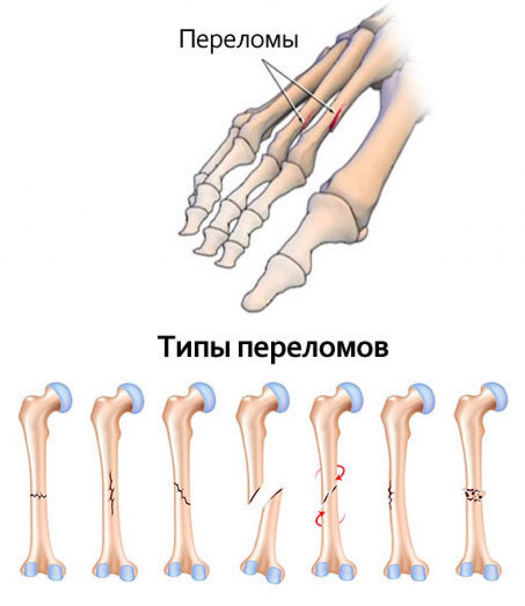 Перелом кости стопы сколько заживает у взрослых