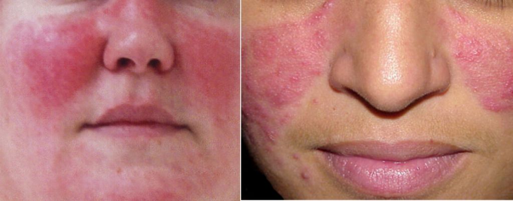 Акне розацеа (acne rosacea): лечение.