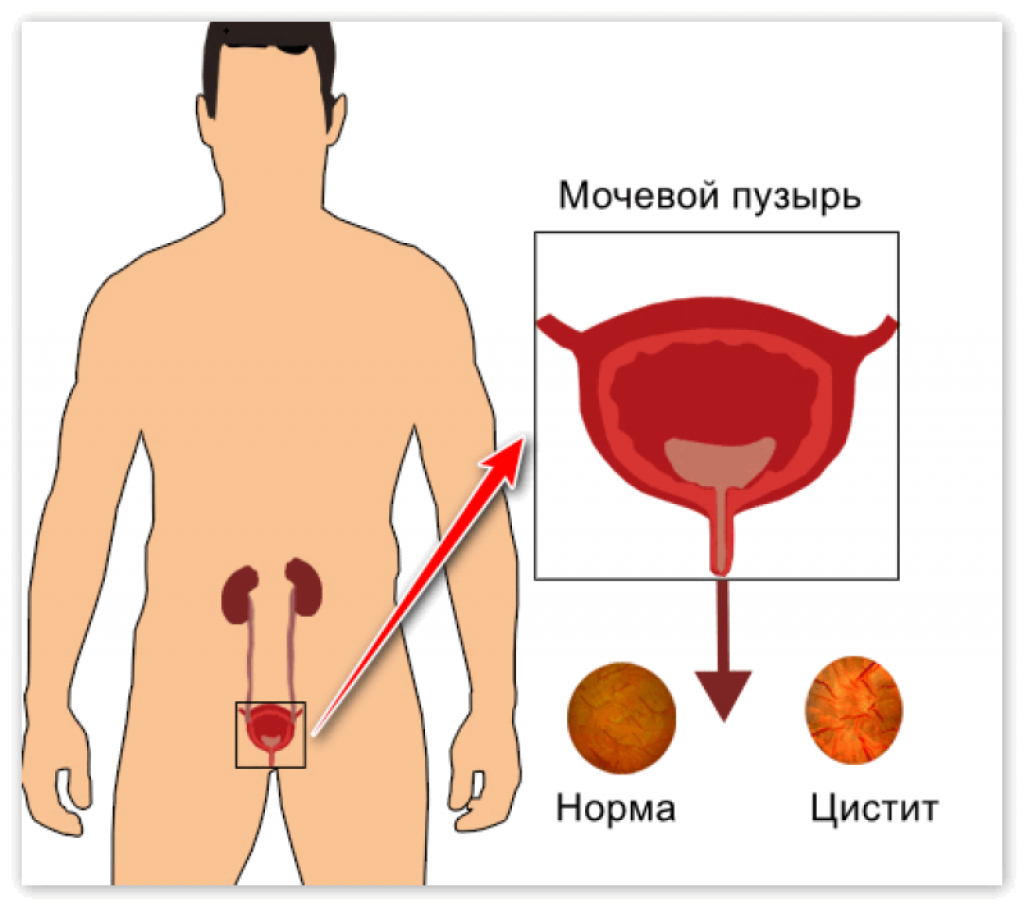 Симптомы мочевого пузыря у мужчин признаки. Воспаление мочевого пузыря у мужчин. Цистит у мужчин симптомы.
