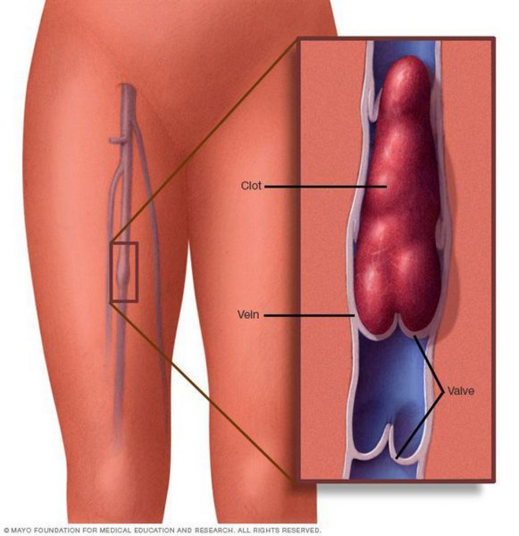 Тромбоэмболия артерий нижних