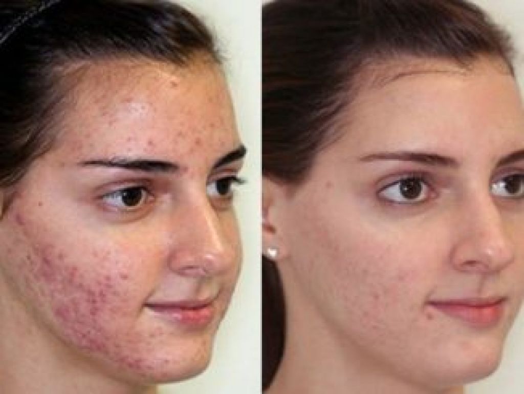 Acne y resistencia a la insulina