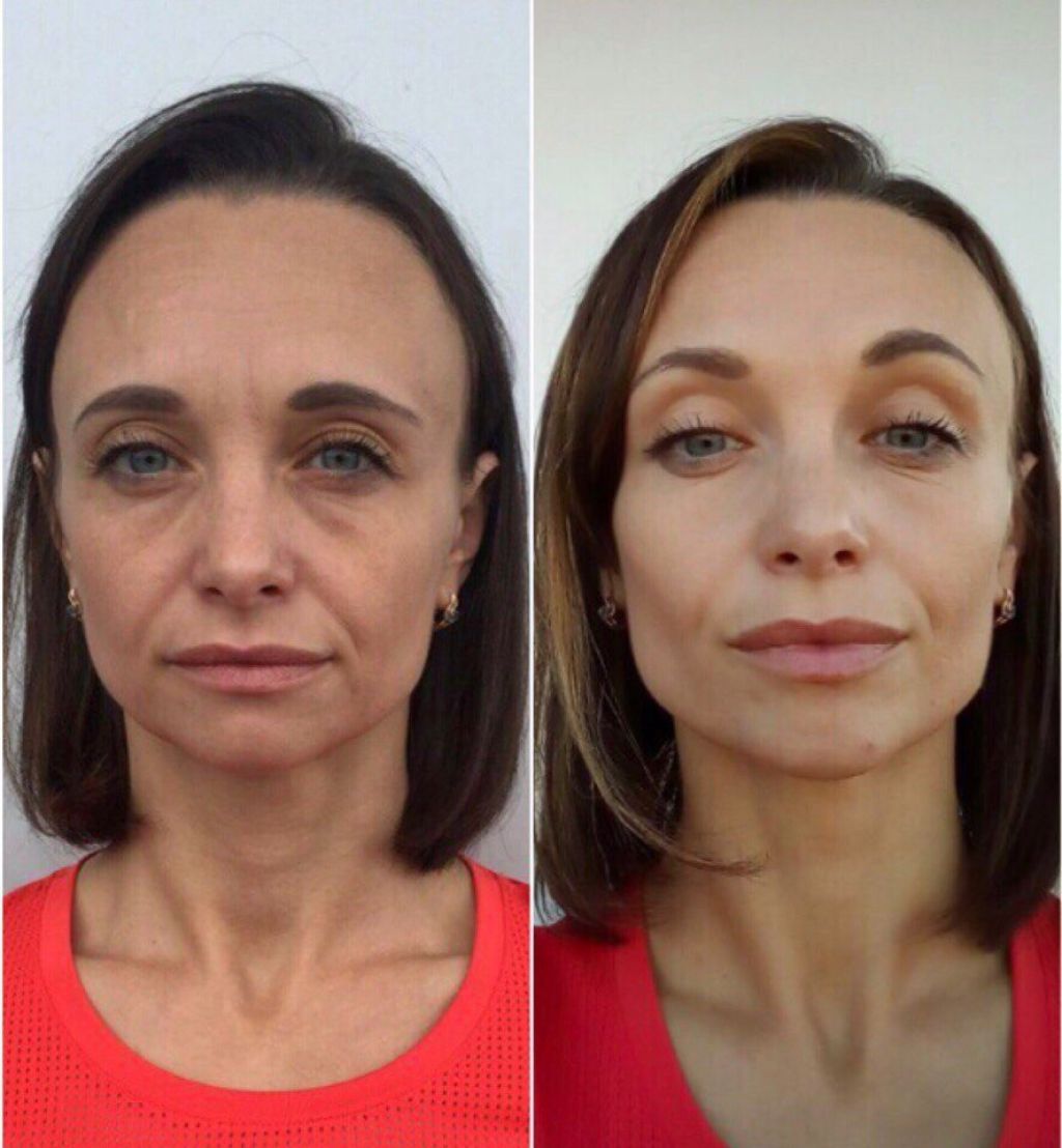 Какая процедура подтягивает лицо. Фейсбилдинга Кэрол Мадджио. Массаж лица до и после. Объемное моделирование лица. Филеры в косметологии.