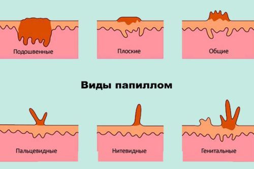 Папилломы в области ануса фото