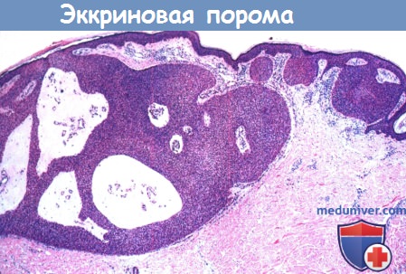 Фото аденокарцинома мейбомиевой железы