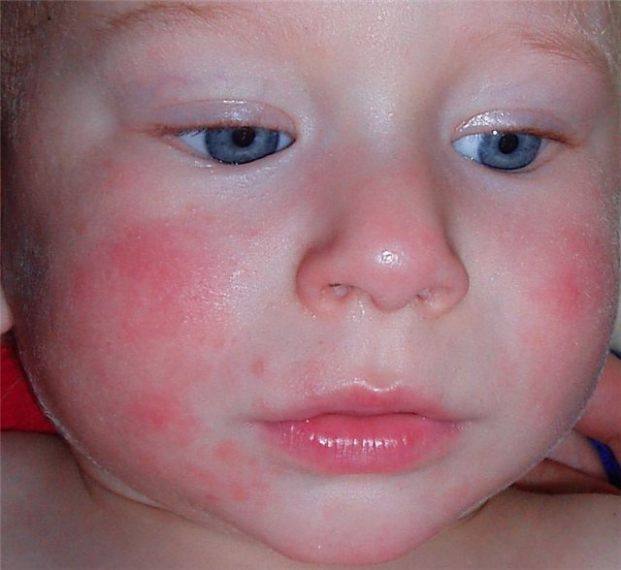 Солнечный дерматит лечение у детей фото
