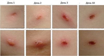 Ветрянка: инкубационный период, сколько дней заразна б остеохандрозе