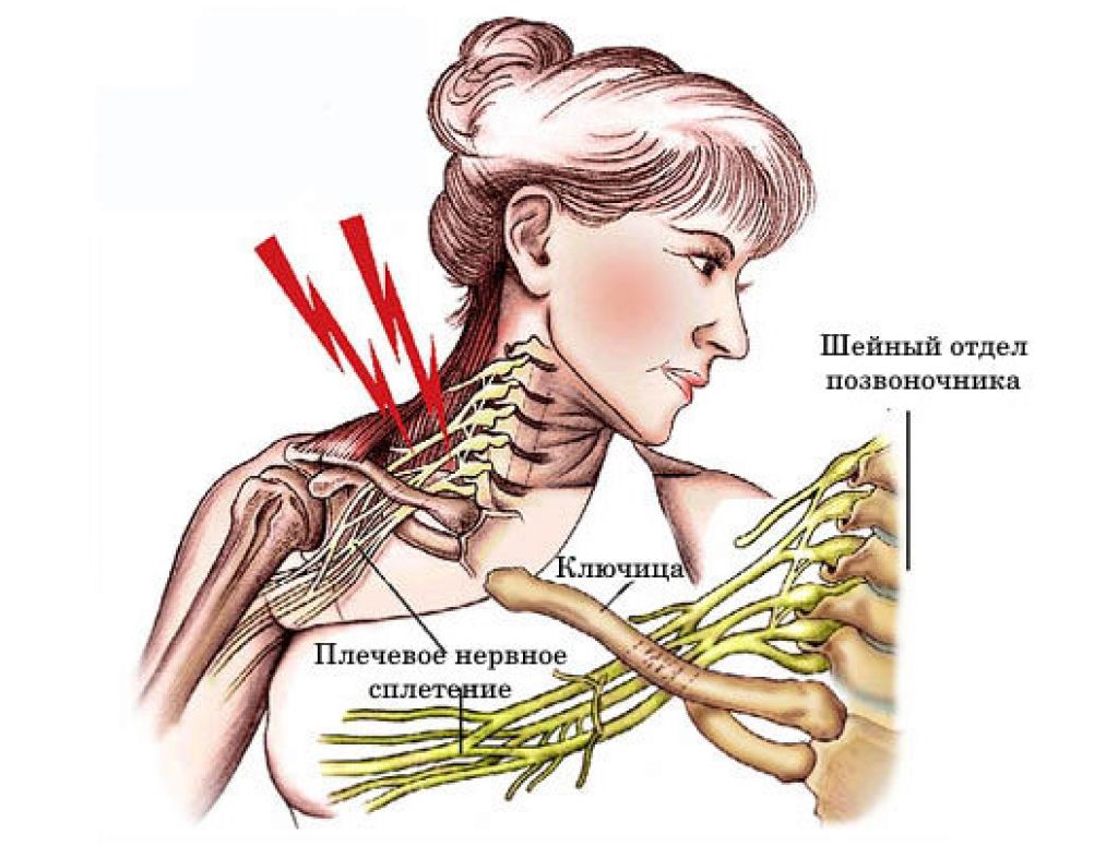 Защемило правую сторону шеи что делать. Плексит плечевого сплетения. Поражение плечевого сплетения неврит. Плексит неврит плечевого нерва. Плексит плечевого сплетения симптомы.