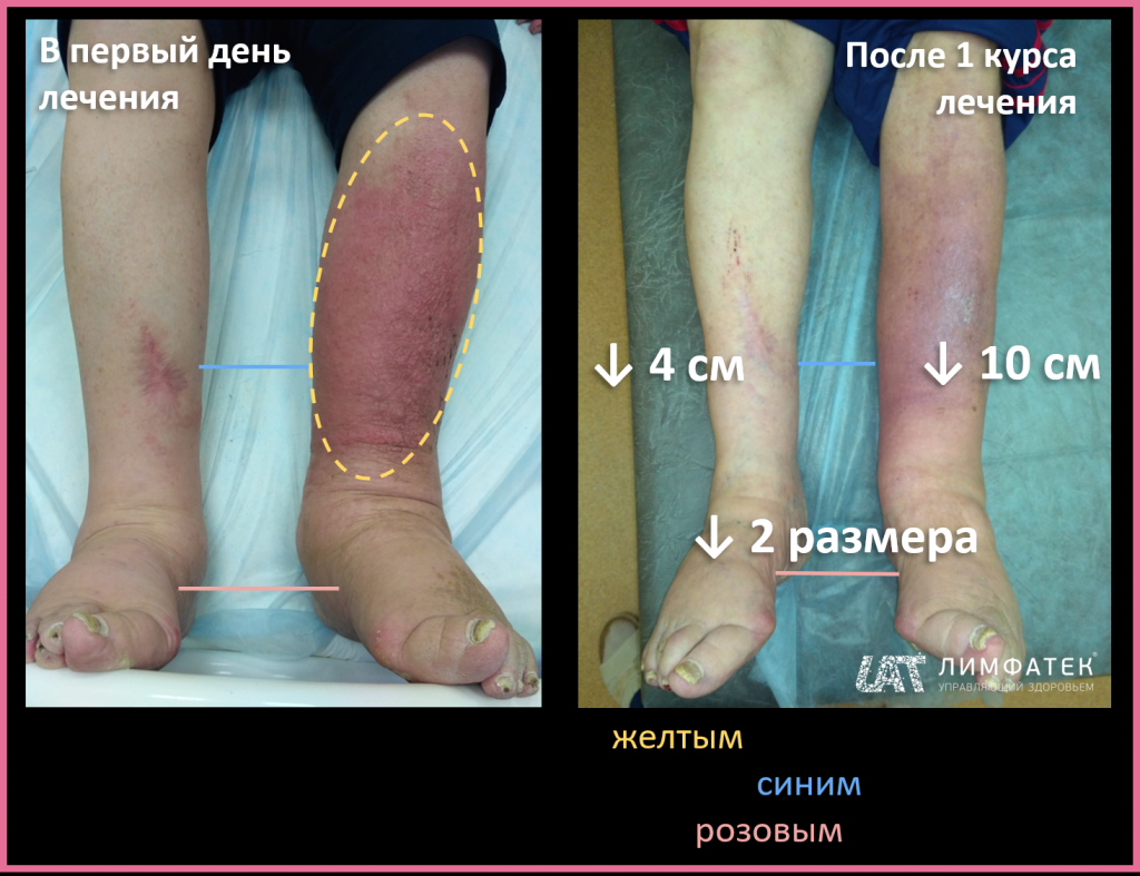 Рожа - лечение народными средствами болезни на ноге