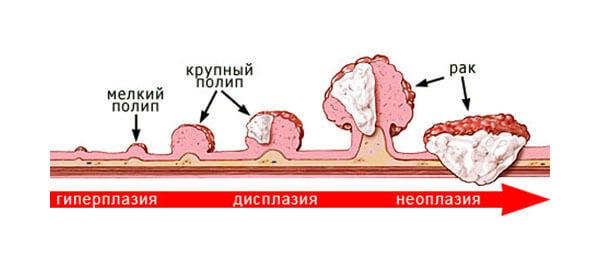 Полипы в желудке фото