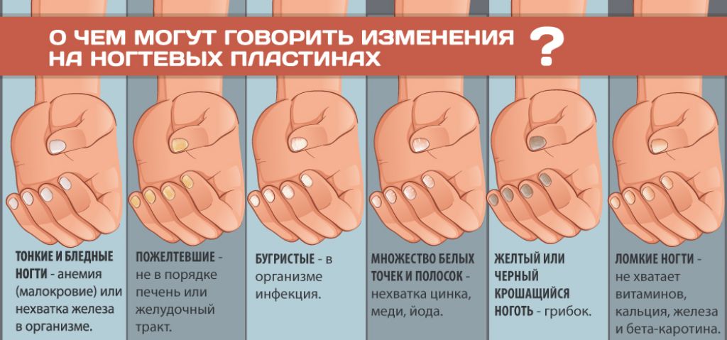 Определение болезни по ногтям. Диагностика по ногтям. Болезни ногтей на руках таблица.