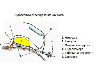 Перламутровые папулы полового члена фото