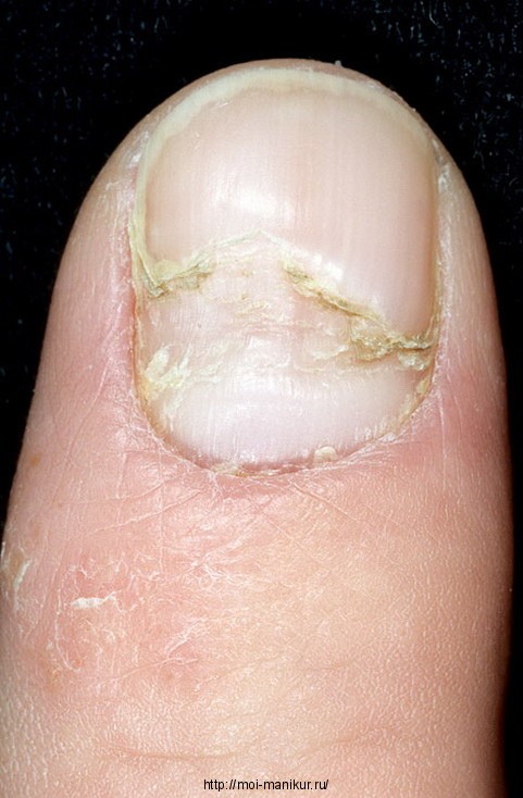 Болезни ногтей на руках и их лечение с фото