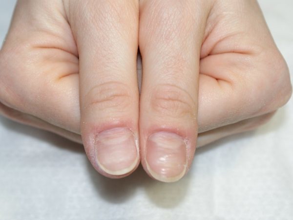 Определить болезнь по ногтям на руках фото