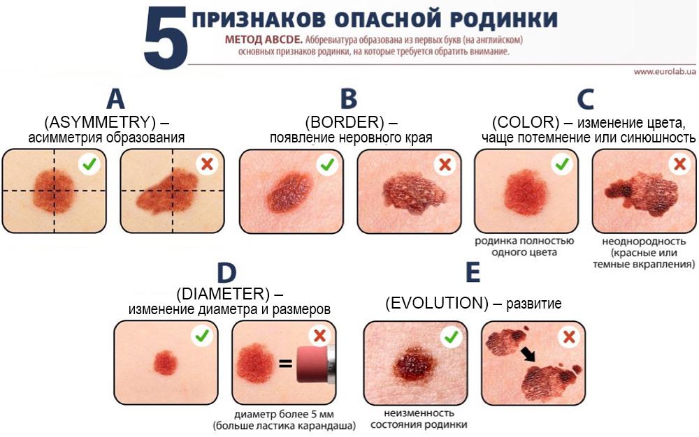 Красные родинки на теле, причины появления, виды, методы лечения и ...