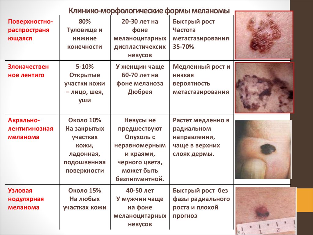 Меланома кожи фото признаки и лечение