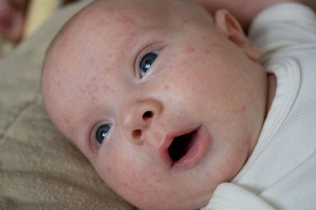 Гормональные прыщи на лице у новорожденного фото