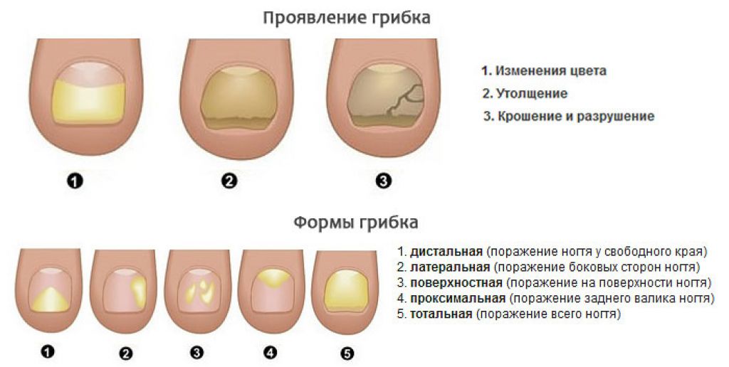 Ногтевые пластины ребристые причина. (Онихомикоз) онихомикоз ногтей. Грибковые болезни ногтей. Грибковые заболевания ногтей на ногах.