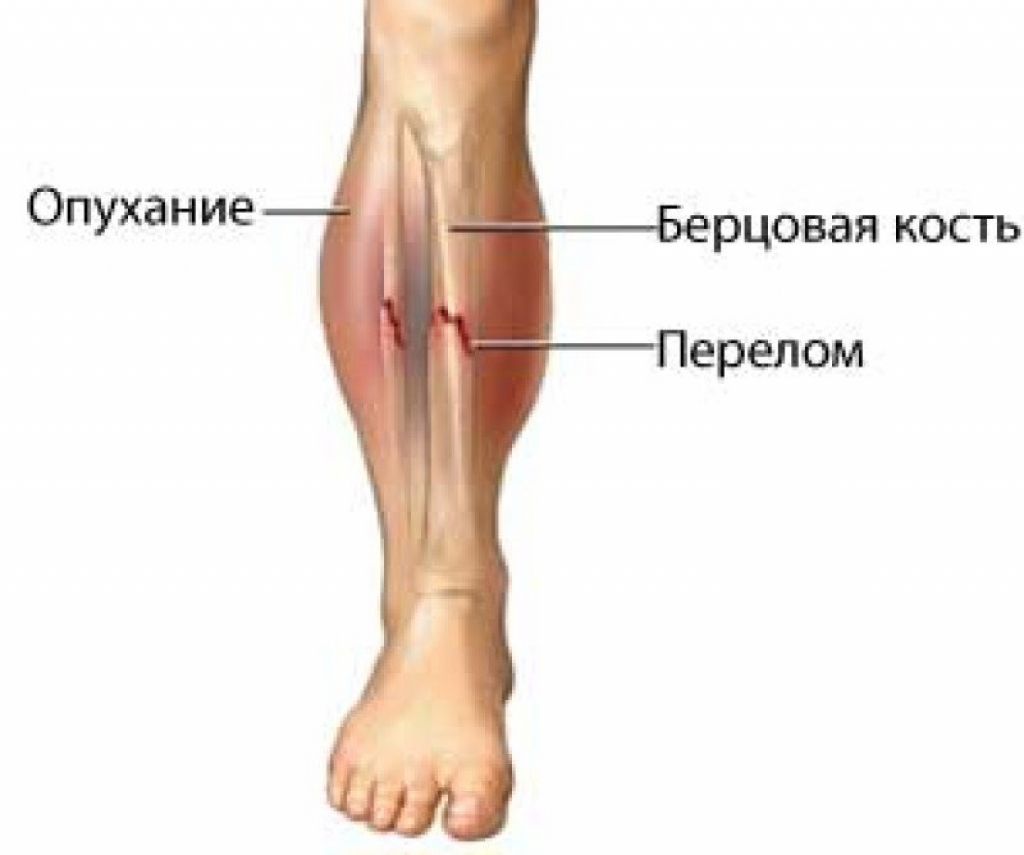 Сколько болит перелом ноги