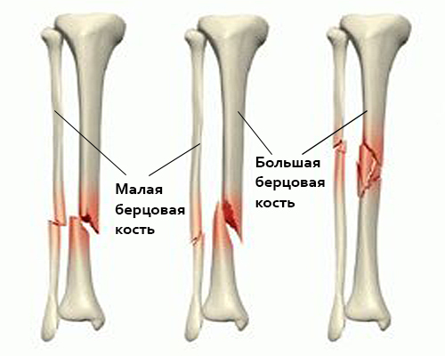 Берцовая кость где находится у человека на ноге фото перелом