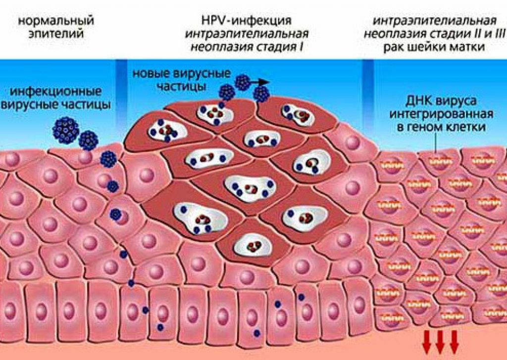 Вирус папилломы человека картинки