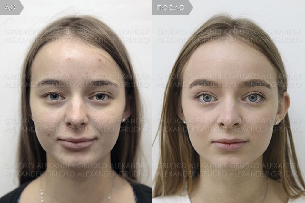 Изменение формы глаза. Блефаропластика до и после фото. Глаза до после.