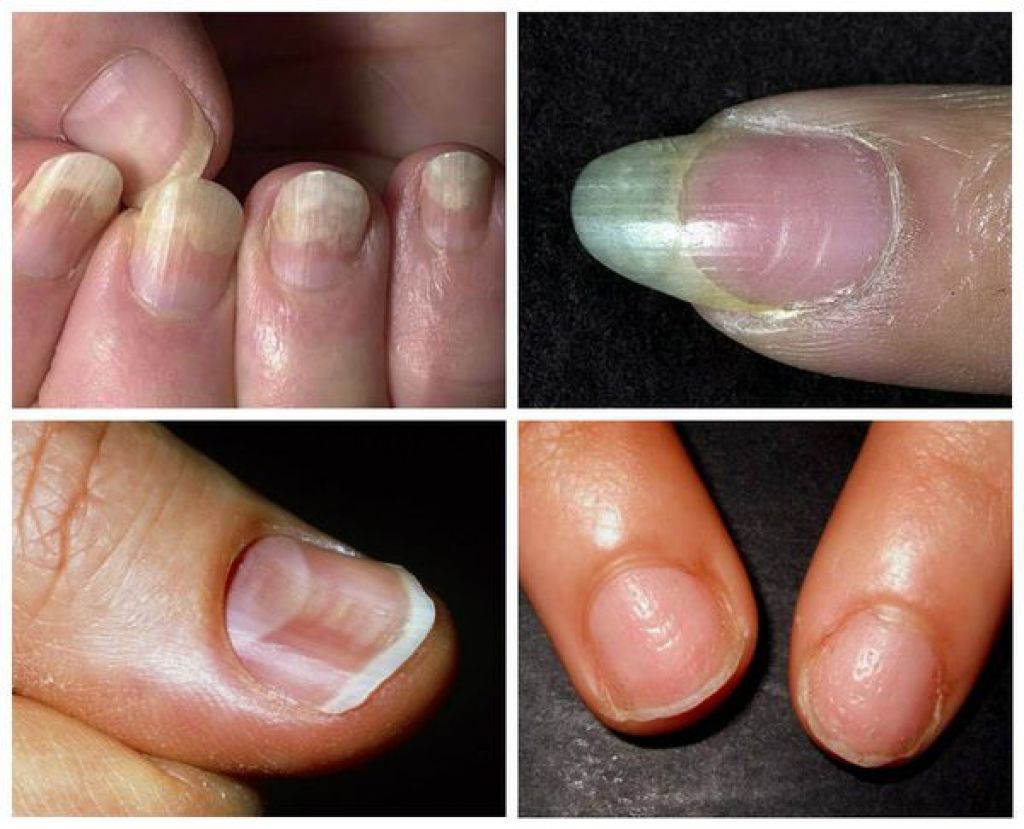 Причины возникновения борозд на ногтях и их лечение