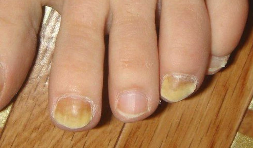 Диагностика по ногтям - признаки для определения заболевания по .