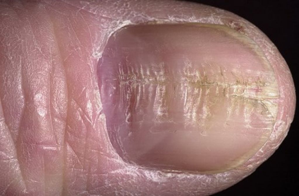 Диагностика по ногтям - признаки для определения заболевания по .
