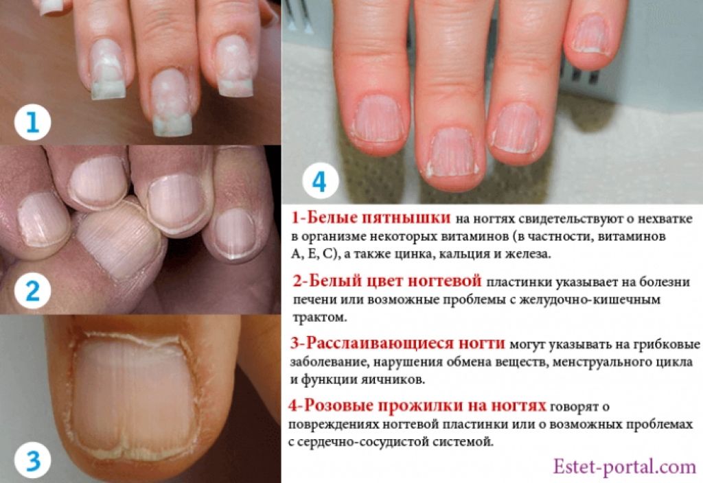 Сверху кожа снизу тоже а в середине. Определить заболевание по ногтям. Белые пятна на ногтях причины. Поперечные полосы на ногтях ног.