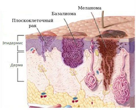 Базалиома стадии фото