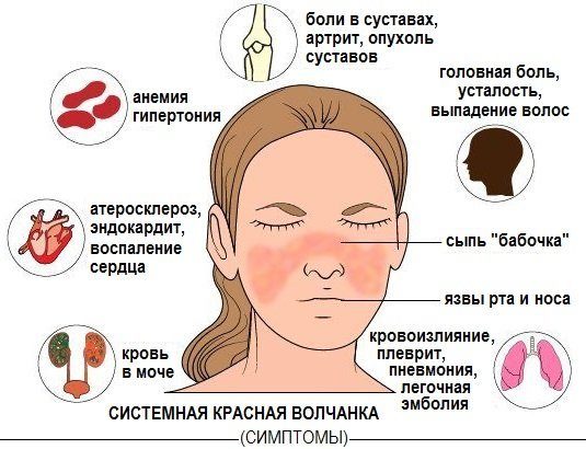 Системная красная волчанка у детей фото