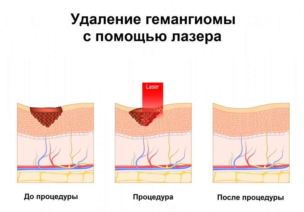 Гемангиома как выглядит фото