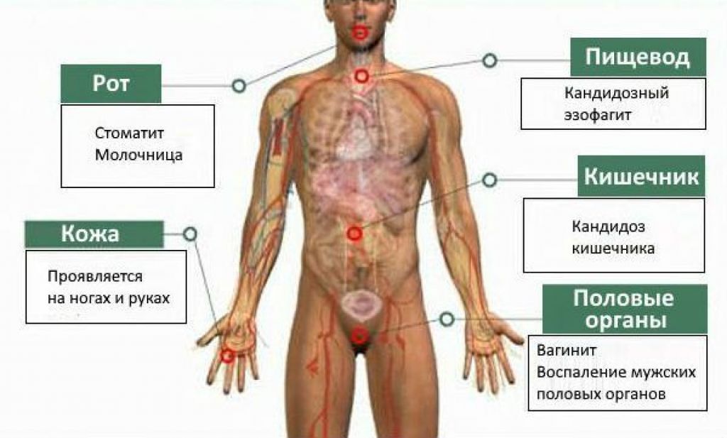 Инфекционные заболевания мужчин. Хронический генерализованный кандидоз. Симптомы ВИЧ на половых органах. Грибковая инфекции в организме человека.