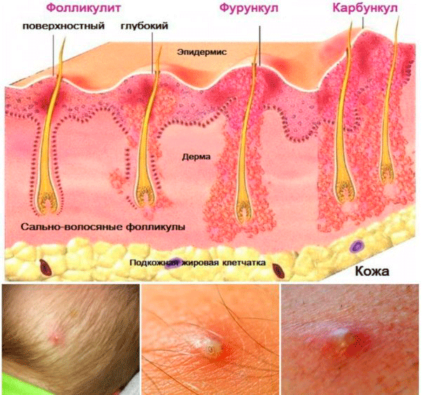 Фолликулит гоффмана фото
