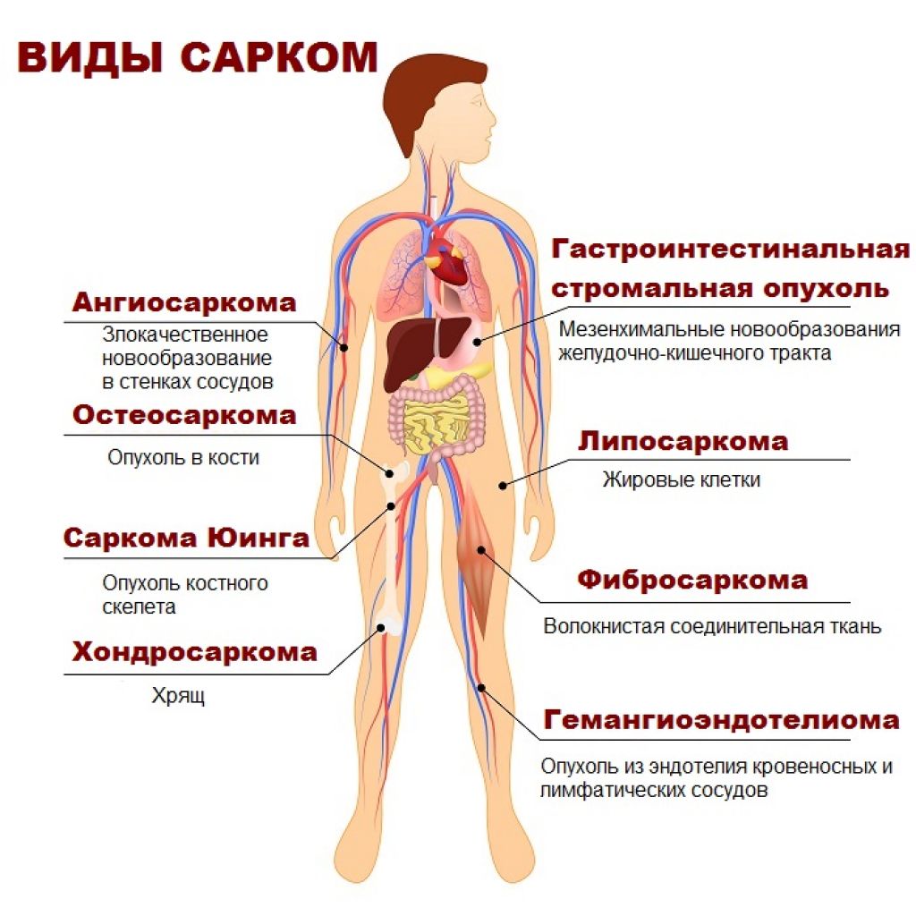 Левый возникнуть. Разновидности фибросаркомы.