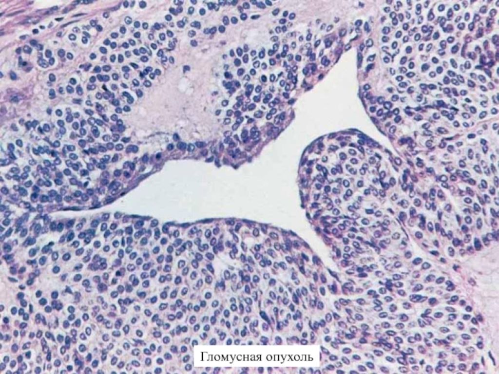 Параганглиома что это. Гломусная опухоль макропрепарат. Гломус ангиома патанатомия.