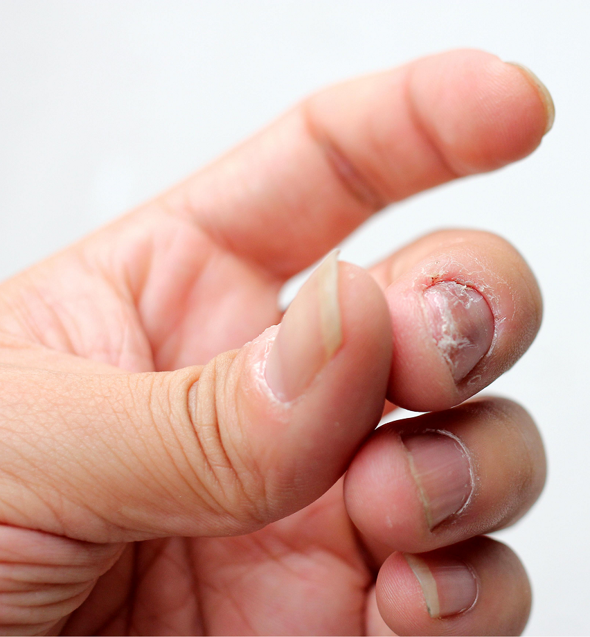 Грибок ногтей на руках - лечение, симптомы, средства | Лечим Грибок