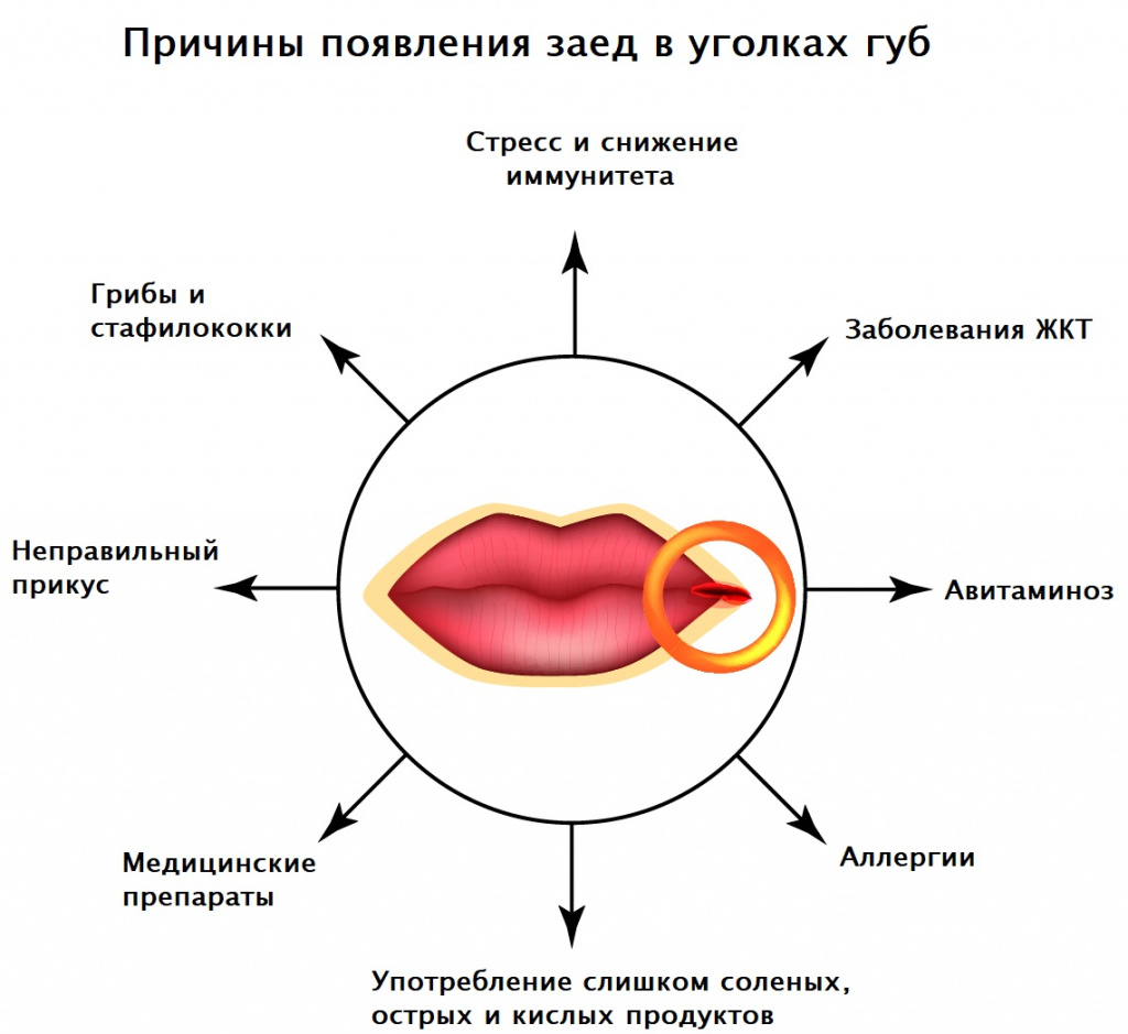 Заеды в уголках рта фото