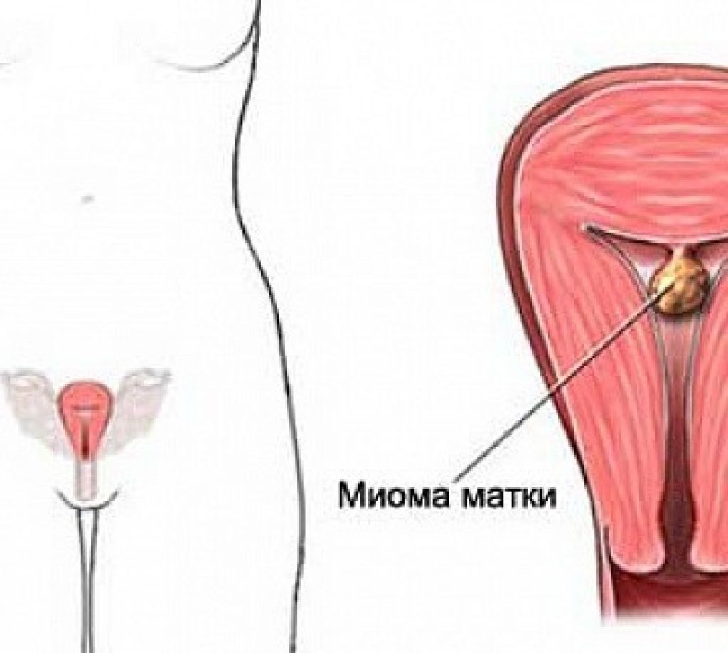 Фибромиома матки что это такое. Фиброма матки операция.