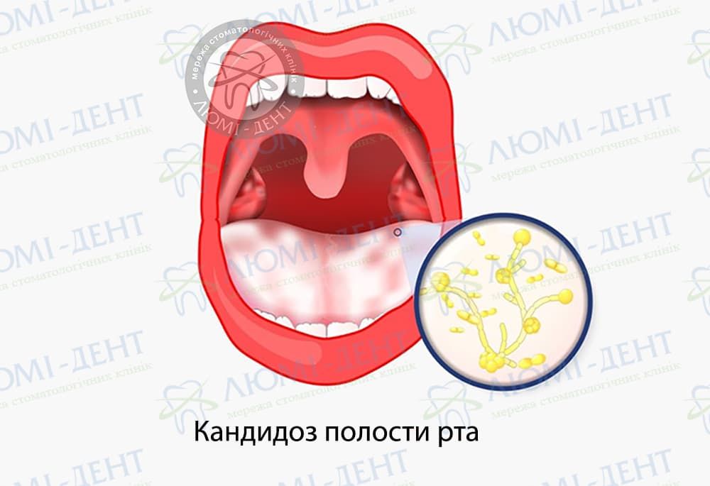 Грибок языка лечение фото