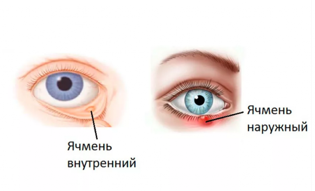 Ячмень начало. Абсцедирующий ячмень Нижнего века. Наружный и внутренний ячмень. Внутренний ячмень офтальмология. Ячмень нижнее веко внутри.