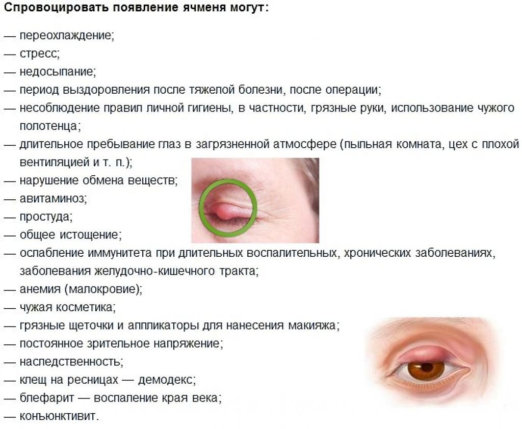 Почему вылезают глаза. Заболевания век ячмень. Этапы формирования ячменя на глазу.