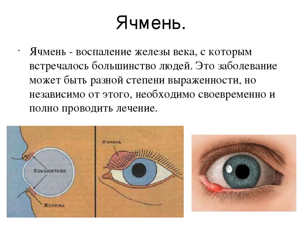 Лечение ячменя в домашних. Этапы развития ячменя на глазу. Как выглядит ячмень на глазу.