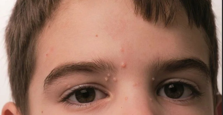 Папилломы на лице у ребенка фото