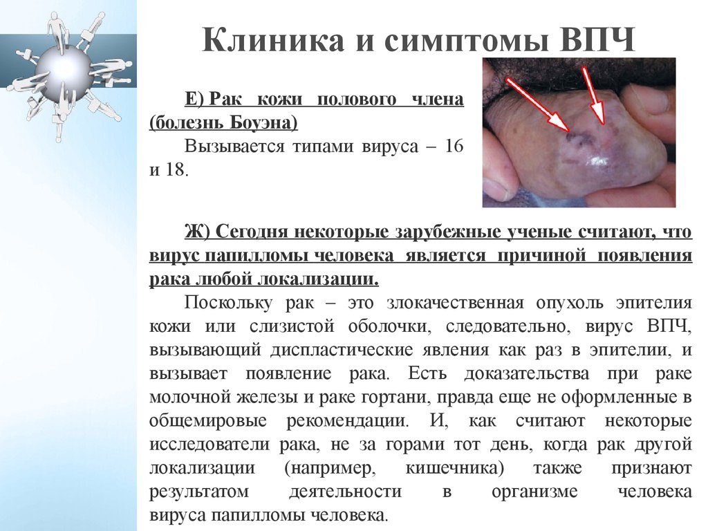 ВПЧ: рак горла, рак гортани, головы, шеи и языка - 16 и 18 тип у женщин ...