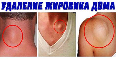 Как выглядят жировики на теле, фото, как избавиться?