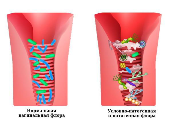 Вульвит у женщин картинки