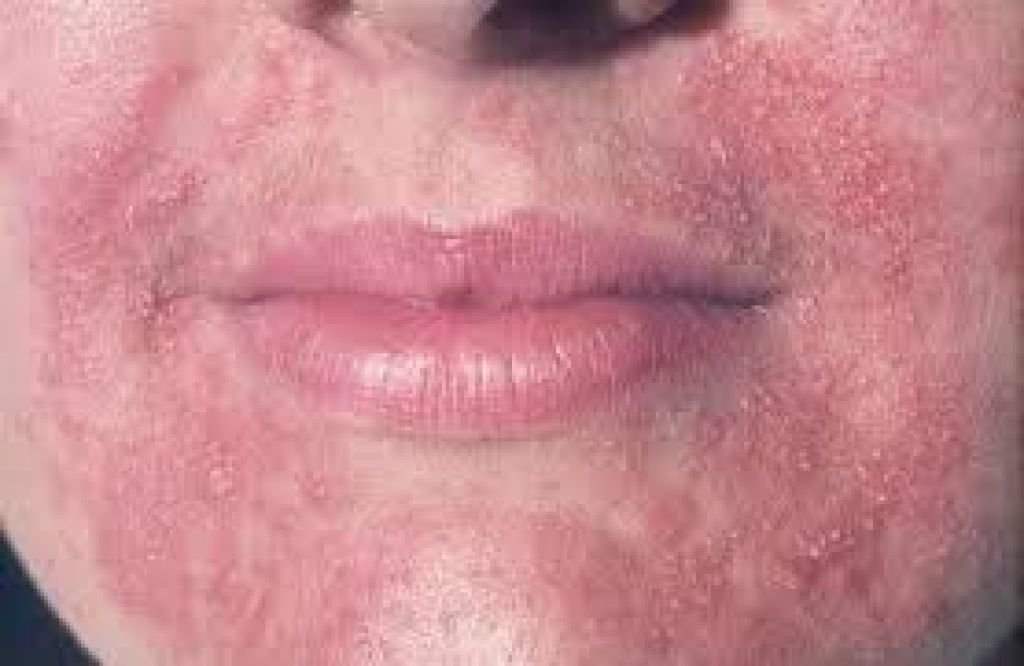 Атопический дерматит у взрослых лечение мази и кремы название фото